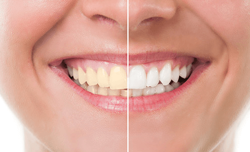 teeth whitening melbourne